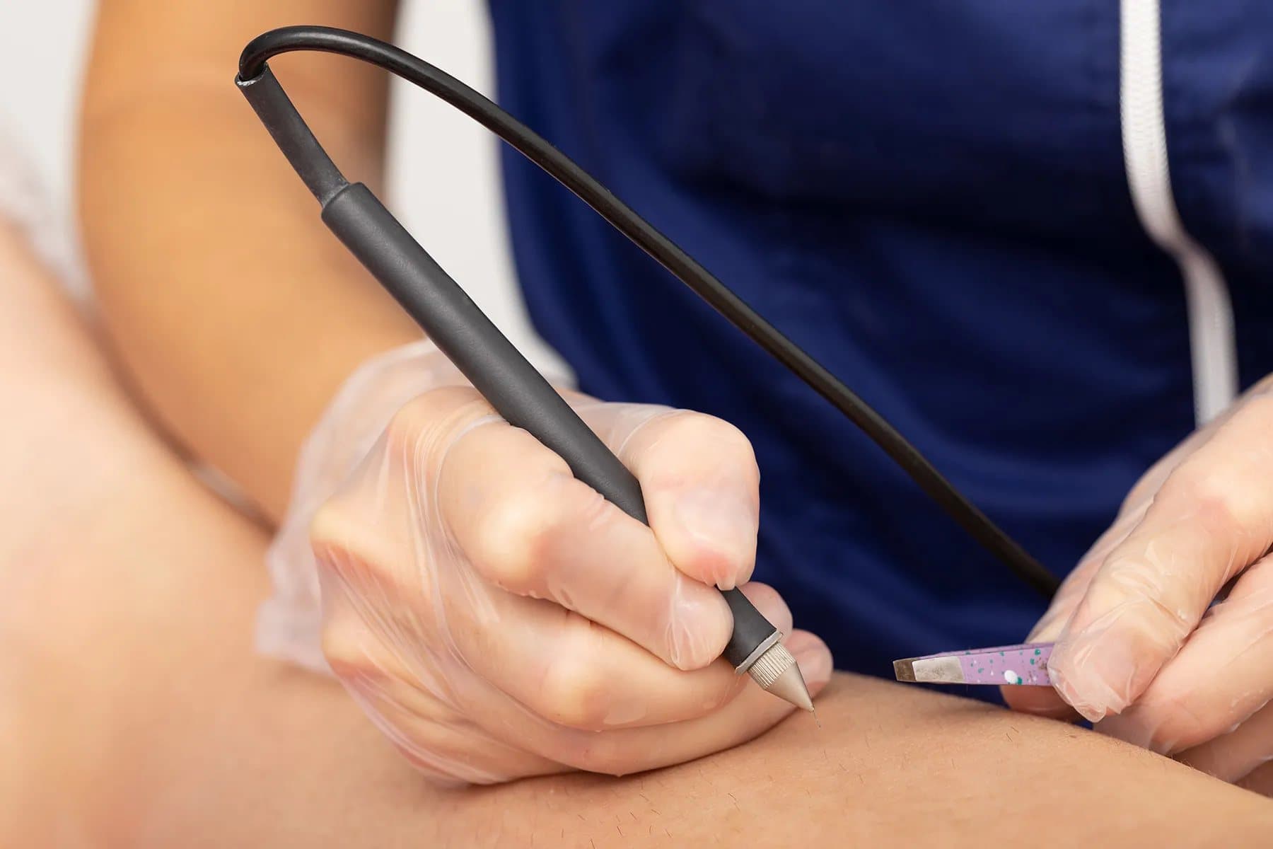 Electrologist holding a probe and tweezers over a client's skin